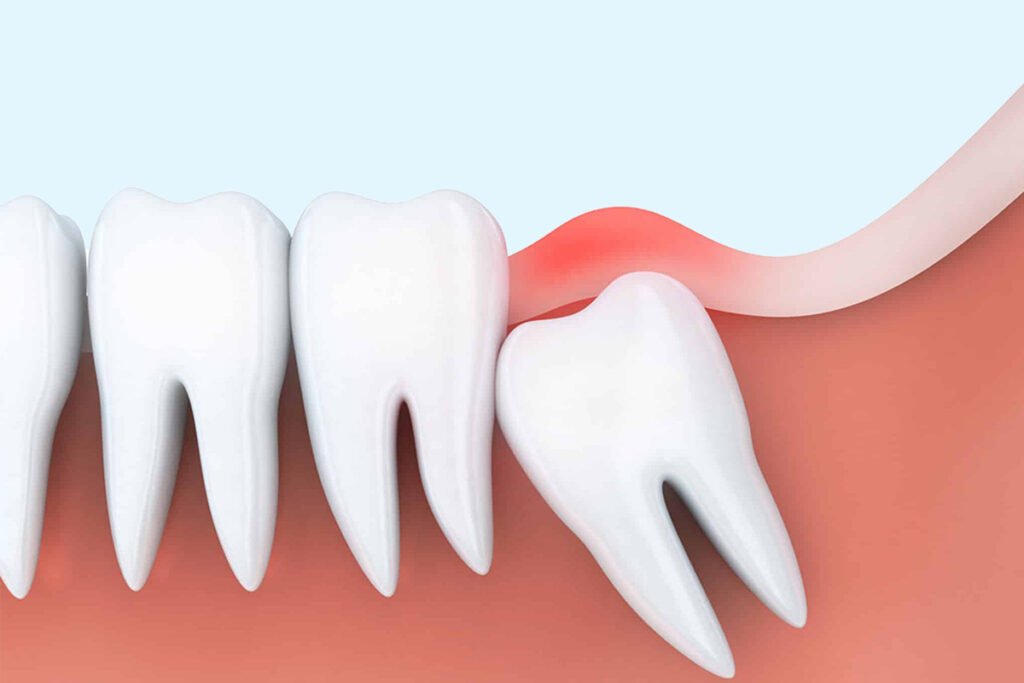 Dr-Naiks-Dental-Studio-Wisdom-tooth-extraction-wisdom-tooth-pain