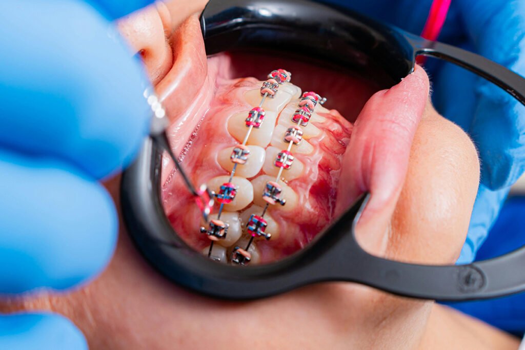 Dr-Naiks-Dental-Studio-Braces-treatments-for-adults-and-kids