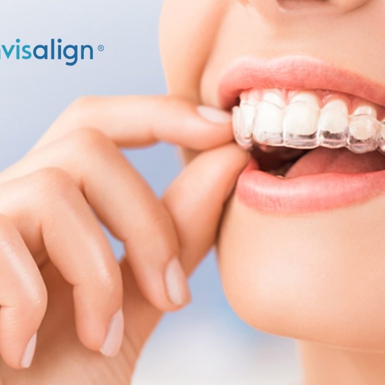 Dr-Naiks-Dental-Studio-invisalign